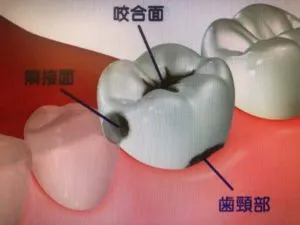 むし歯好発部位