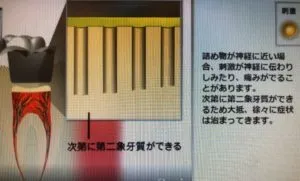 むし歯