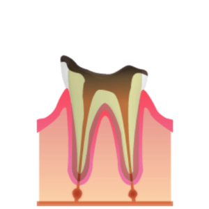 熊本市東区長嶺南のすけひろ歯科・kidsデンタルクリニック　C4 歯根に達したむし歯
