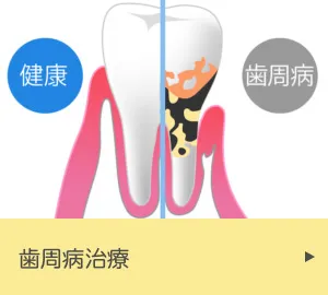 歯周病治療