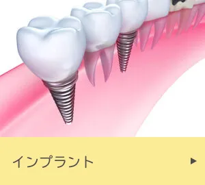 インプラント